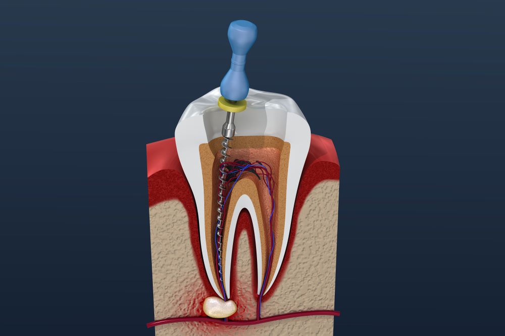 What is Root Canal Therapy and When Do You Need It? Dr. Paula J. Schmidt Dr. Braiden Jorgensen Dental Care of Jackson Hole General, Cosmetic, Restorative, Preventative, Family Dentist in Jackson, WY 83001